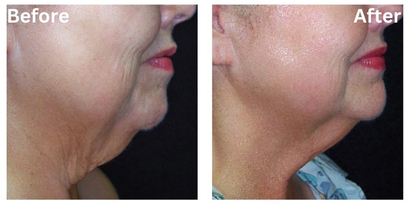 Results Permanent Choice Permanent Choice Laser Hair Removal